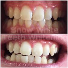 Snowhite Teeth Whitening – prix – pas cher – effets